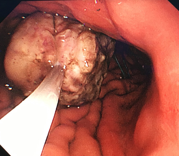 内镜中心完成1例内镜下胃底间质瘤的胃壁全层切除手术