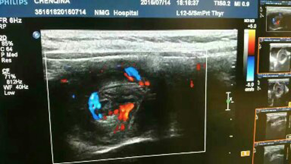 超声引导下温盐水灌肠  肠套叠患儿的福音
