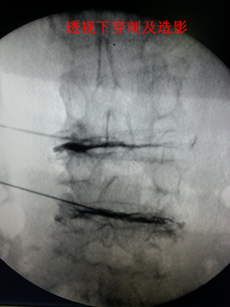 穿刺造影(2).jpg